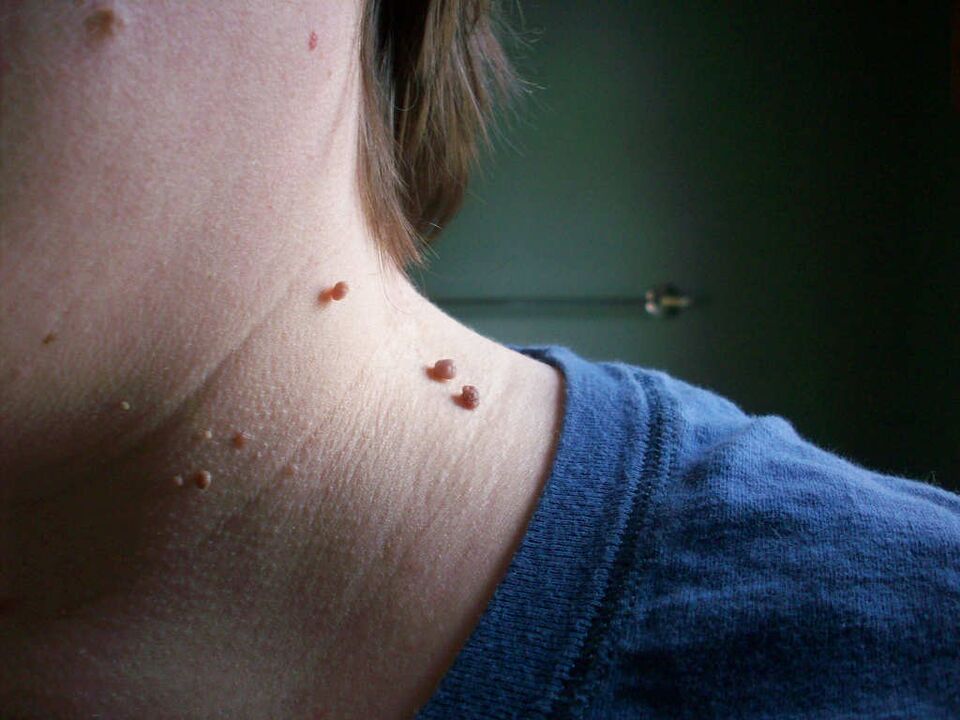 papilomas en el cuello como tratar